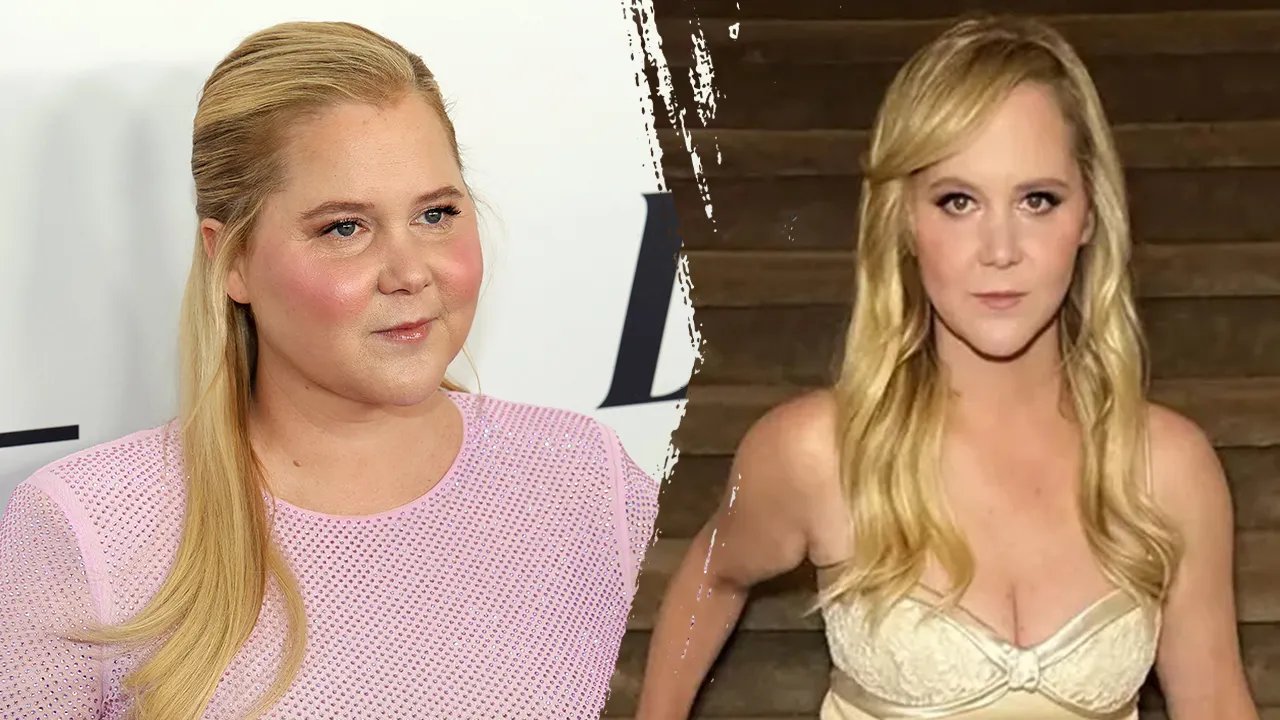 What to know about Cushing’s syndrome, which led to Amy Schumer's dramatic weight loss